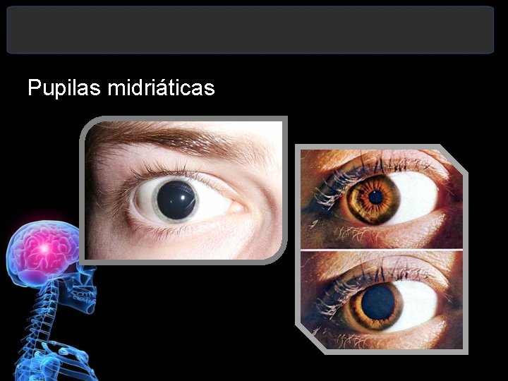 Pupilas midriáticas 