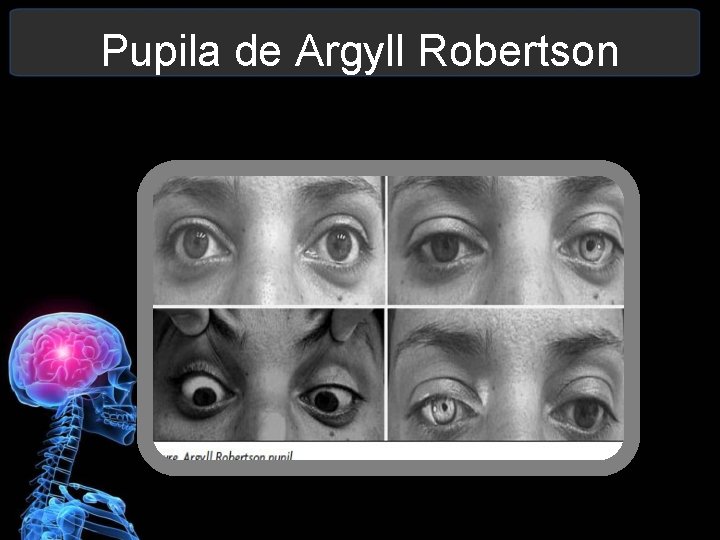 Pupila de Argyll Robertson 