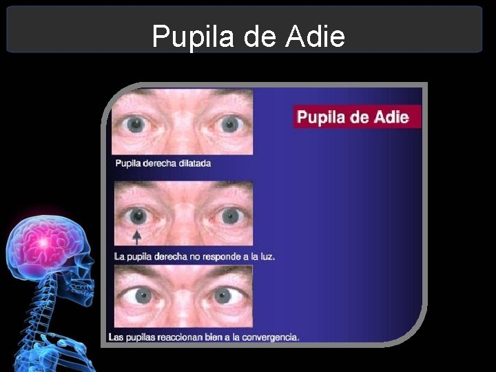 Pupila de Adie 