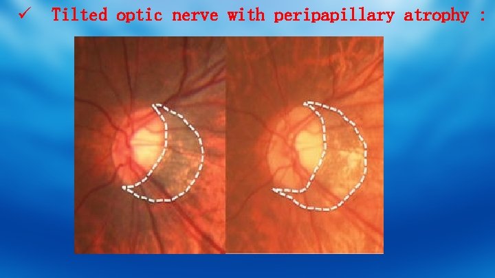 ü Tilted optic nerve with peripapillary atrophy : 