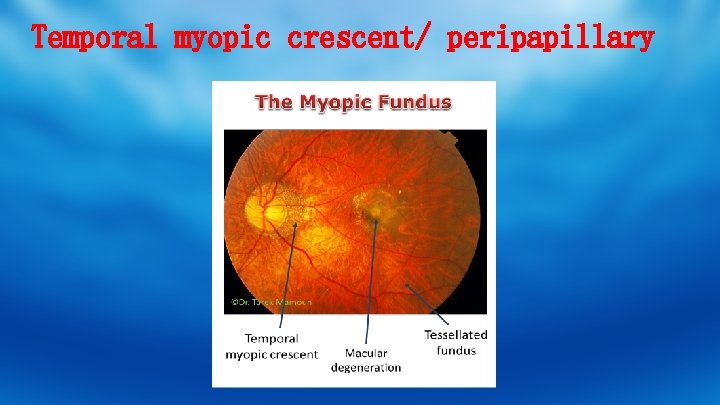 Temporal myopic crescent/ peripapillary 