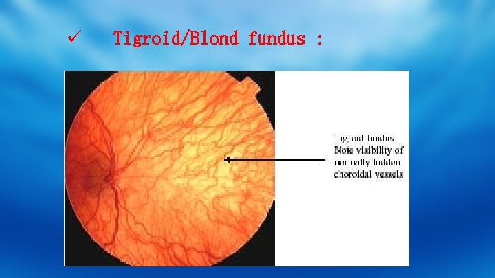 ü Tigroid/Blond fundus : 