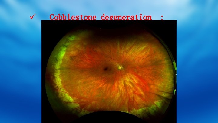 ü Cobblestone degeneration : 