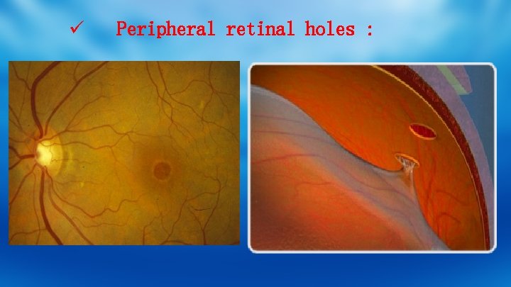 ü Peripheral retinal holes : 
