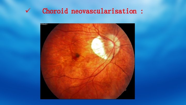 ü Choroid neovascularisation : 