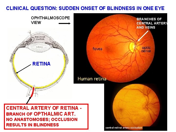 CLINICAL QUESTION: SUDDEN ONSET OF BLINDNESS IN ONE EYE OPHTHALMOSCOPE VIEW RETINA CENTRAL ARTERY