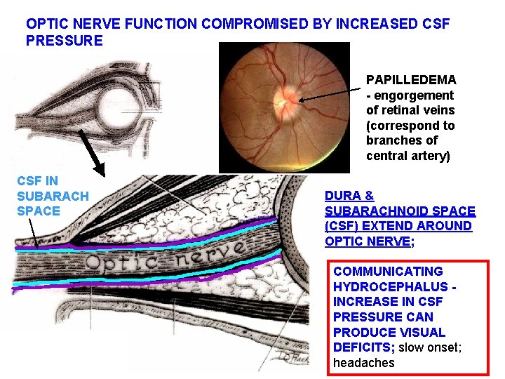 OPTIC NERVE FUNCTION COMPROMISED BY INCREASED CSF PRESSURE PAPILLEDEMA - engorgement of retinal veins