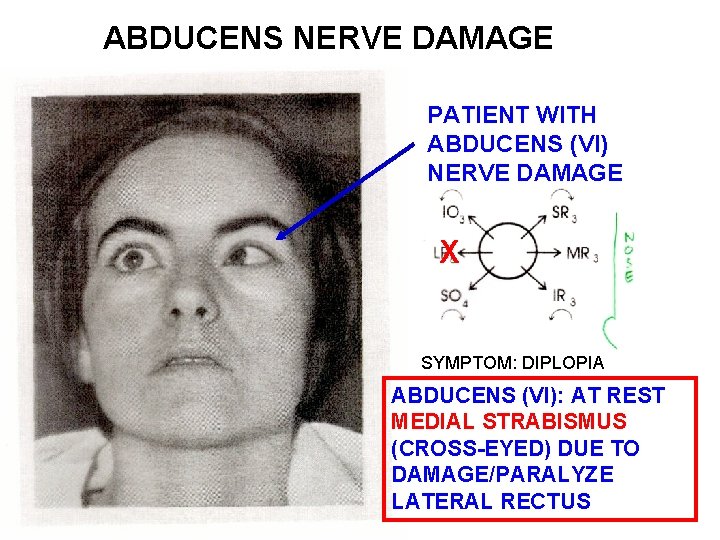 ABDUCENS NERVE DAMAGE PATIENT WITH ABDUCENS (VI) NERVE DAMAGE X SYMPTOM: DIPLOPIA ABDUCENS (VI):