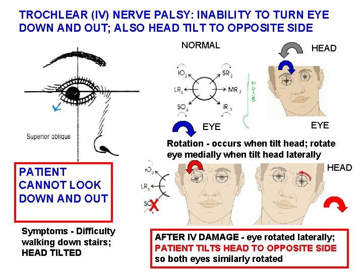 TROCHLEAR (IV) NERVE PALSY: INABILITY TO TURN EYE DOWN AND OUT; ALSO HEAD TILT