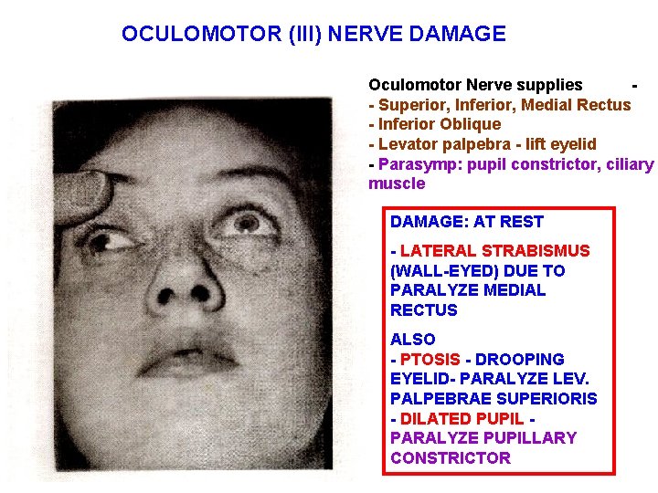 OCULOMOTOR (III) NERVE DAMAGE Oculomotor Nerve supplies - Superior, Inferior, Medial Rectus - Inferior