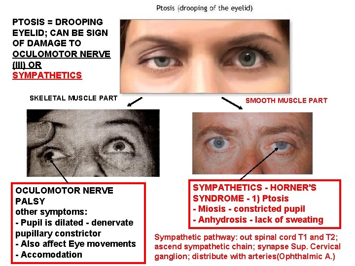 PTOSIS = DROOPING EYELID; CAN BE SIGN OF DAMAGE TO OCULOMOTOR NERVE (III) OR