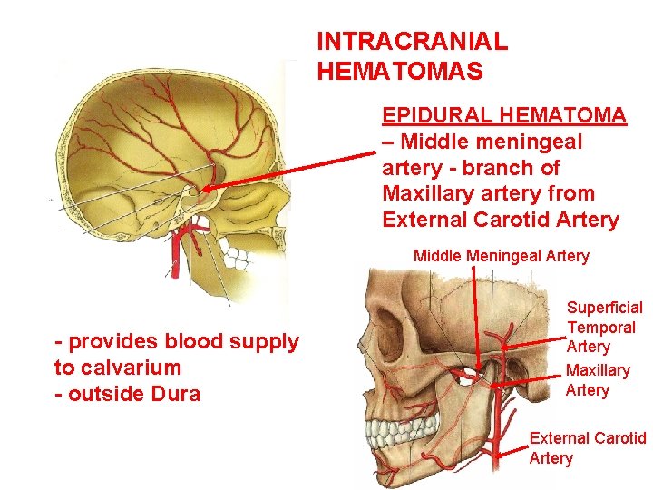 INTRACRANIAL HEMATOMAS EPIDURAL HEMATOMA – Middle meningeal artery - branch of Maxillary artery from