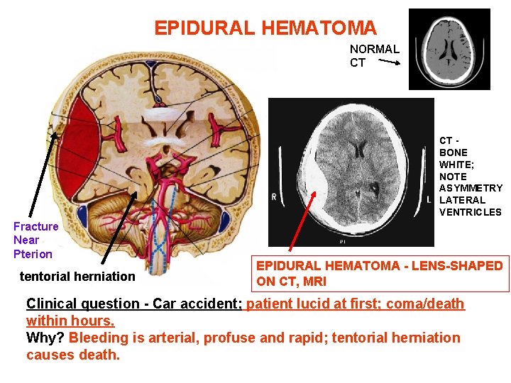 EPIDURAL HEMATOMA NORMAL CT CT BONE WHITE; NOTE ASYMMETRY LATERAL VENTRICLES Fracture Near Pterion