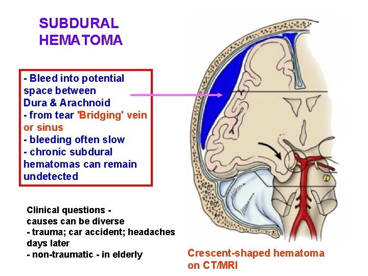 SUBDURAL HEMATOMA - Bleed into potential space between Dura & Arachnoid - from tear