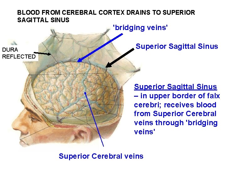 BLOOD FROM CEREBRAL CORTEX DRAINS TO SUPERIOR SAGITTAL SINUS 'bridging veins' DURA REFLECTED Superior