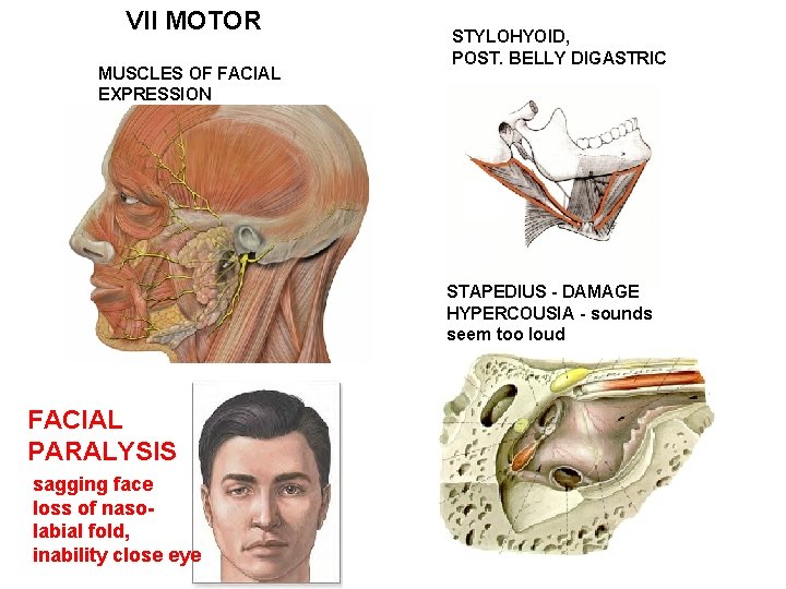 VII MOTOR MUSCLES OF FACIAL EXPRESSION STYLOHYOID, POST. BELLY DIGASTRIC STAPEDIUS - DAMAGE HYPERCOUSIA