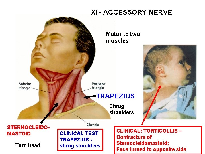 XI - ACCESSORY NERVE Motor to two muscles TRAPEZIUS Shrug shoulders STERNOCLEIDOMASTOID Turn head