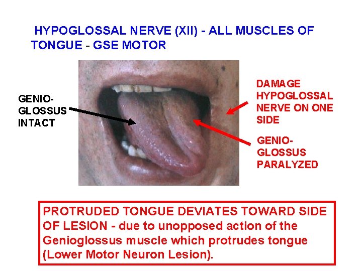  HYPOGLOSSAL NERVE (XII) - ALL MUSCLES OF TONGUE - GSE MOTOR GENIOGLOSSUS INTACT