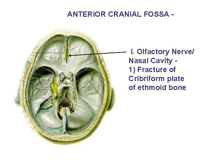 ANTERIOR CRANIAL FOSSA - I. Olfactory Nerve/ Nasal Cavity 1) Fracture of Cribriform plate