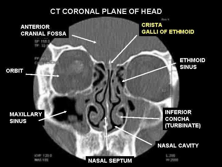 CT CORONAL PLANE OF HEAD CRISTA GALLI OF ETHMOID ANTERIOR CRANIAL FOSSA ETHMOID SINUS