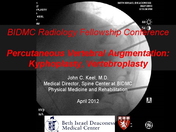 BIDMC Radiology Fellowship Conference Percutaneous Vertebral Augmentation: Kyphoplasty, Vertebroplasty John C. Keel, M. D.