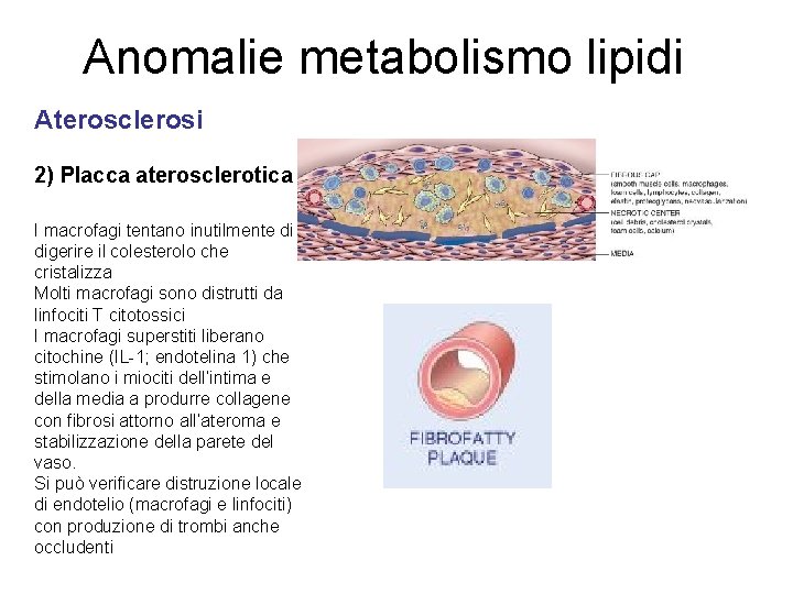 Anomalie metabolismo lipidi Aterosclerosi 2) Placca aterosclerotica I macrofagi tentano inutilmente di digerire il