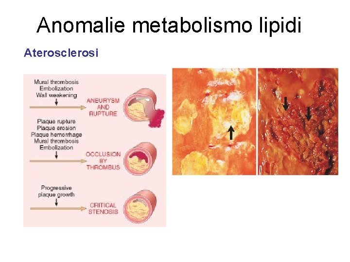 Anomalie metabolismo lipidi Aterosclerosi 