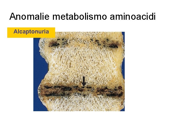 Anomalie metabolismo aminoacidi Alcaptonuria 