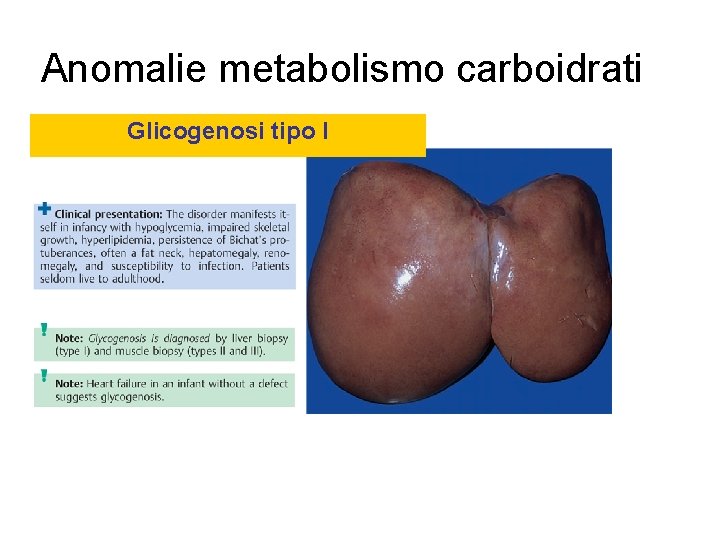 Anomalie metabolismo carboidrati Glicogenosi tipo I 