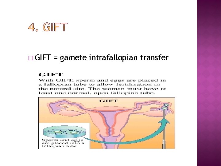 � GIFT = gamete intrafallopian transfer 