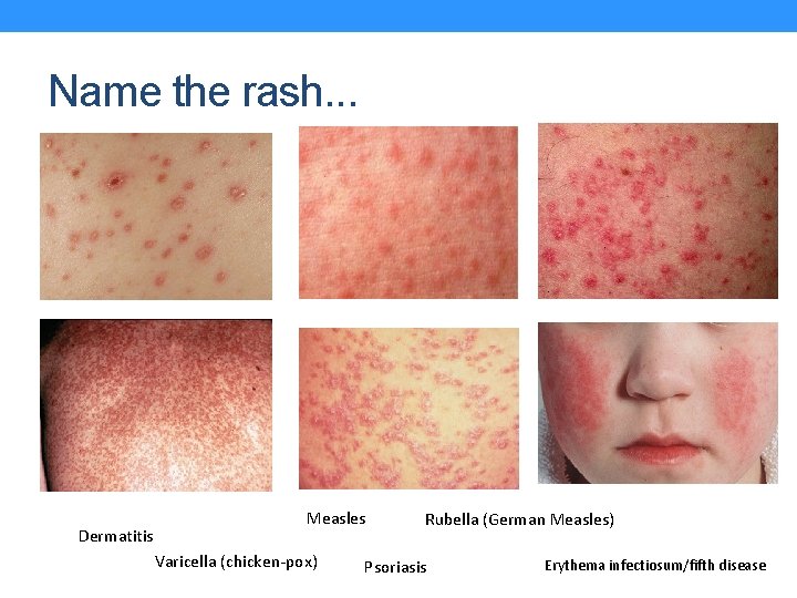 Name the rash. . . Dermatitis Measles Varicella (chicken-pox) Rubella (German Measles) Psoriasis Erythema