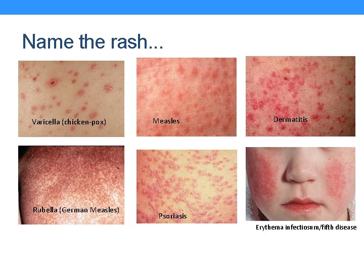 Name the rash. . . Varicella (chicken-pox) Rubella (German Measles) Measles Dermatitis Psoriasis Erythema