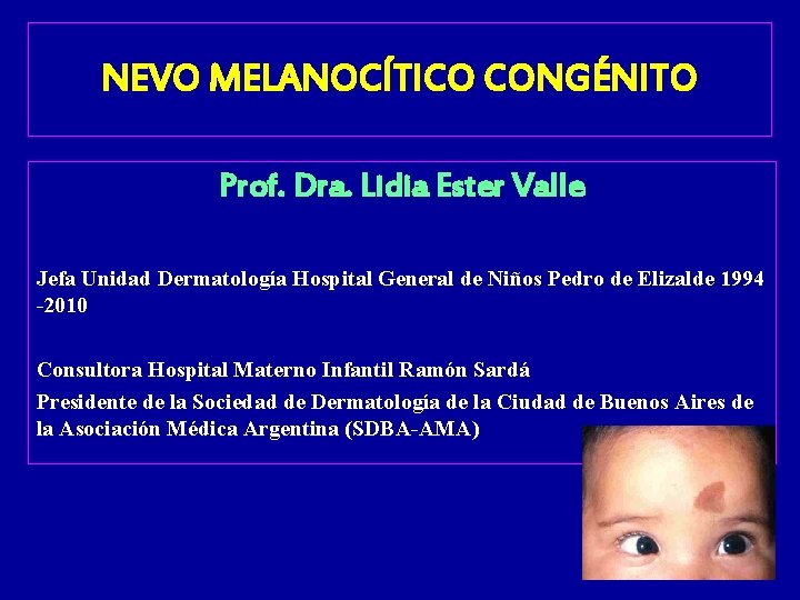 NEVO MELANOCÍTICO CONGÉNITO Prof. Dra. Lidia Ester Valle Jefa Unidad Dermatología Hospital General de