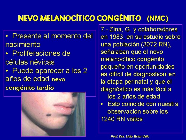 NEVO MELANOCÍTICO CONGÉNITO (NMC) 7. - Zina, G. y colaboradores • Presente al momento