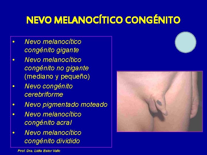 NEVO MELANOCÍTICO CONGÉNITO • • • Nevo melanocítico congénito gigante Nevo melanocítico congénito no