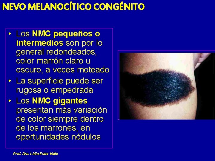 NEVO MELANOCÍTICO CONGÉNITO • Los NMC pequeños o intermedios son por lo general redondeados,