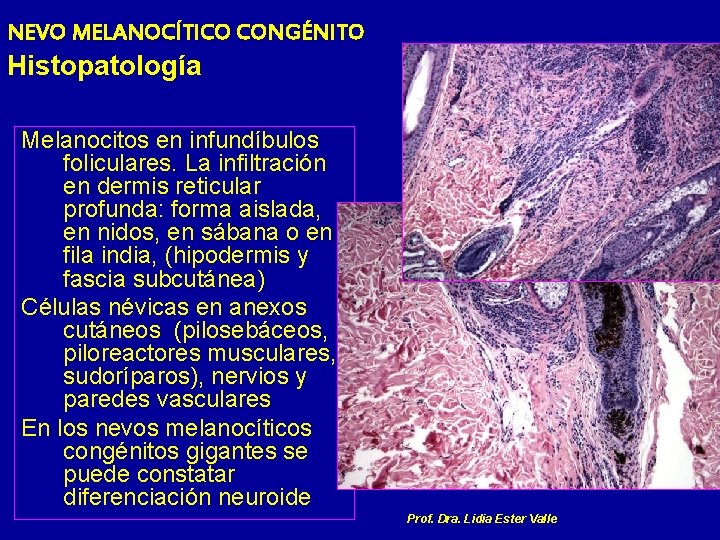 NEVO MELANOCÍTICO CONGÉNITO Histopatología Melanocitos en infundíbulos foliculares. La infiltración en dermis reticular profunda:
