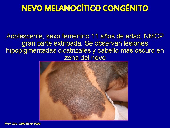 NEVO MELANOCÍTICO CONGÉNITO Adolescente, sexo femenino 11 años de edad, NMCP gran parte extirpada.