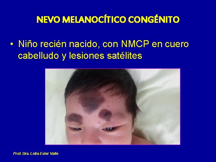 NEVO MELANOCÍTICO CONGÉNITO • Niño recién nacido, con NMCP en cuero cabelludo y lesiones