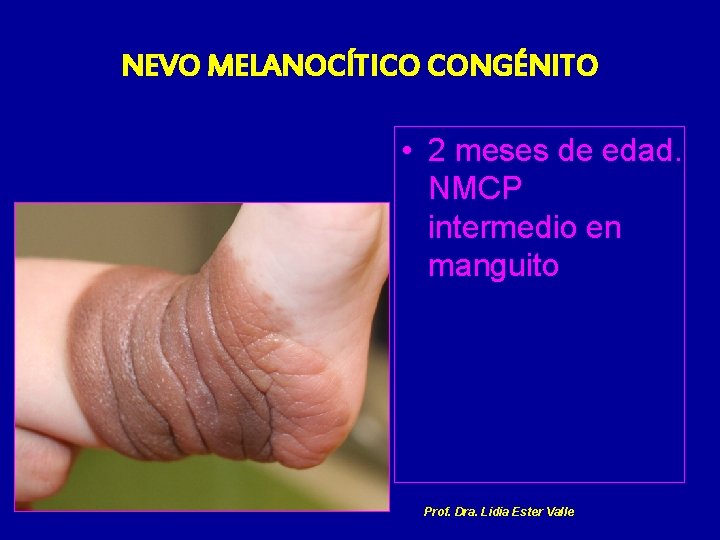 NEVO MELANOCÍTICO CONGÉNITO • 2 meses de edad. NMCP intermedio en manguito Prof. Dra.