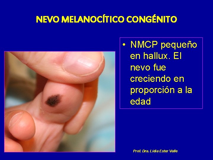 NEVO MELANOCÍTICO CONGÉNITO • NMCP pequeño en hallux. El nevo fue creciendo en proporción