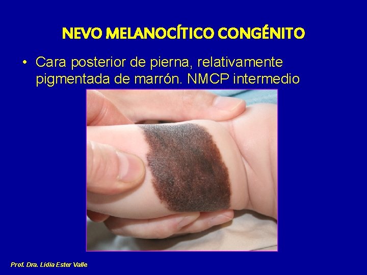 NEVO MELANOCÍTICO CONGÉNITO • Cara posterior de pierna, relativamente pigmentada de marrón. NMCP intermedio