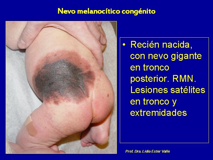 Nevo melanocítico congénito • Recién nacida, con nevo gigante en tronco posterior. RMN. Lesiones