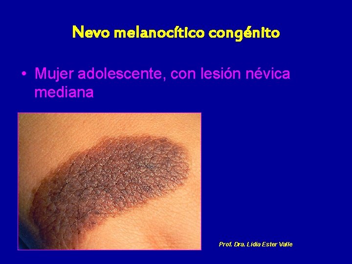 Nevo melanocítico congénito • Mujer adolescente, con lesión névica mediana Prof. Dra. Lidia Ester