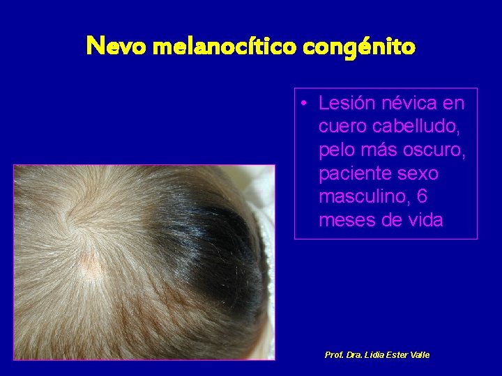 Nevo melanocítico congénito • Lesión névica en cuero cabelludo, pelo más oscuro, paciente sexo