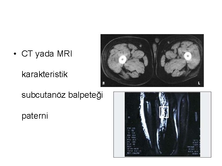  • CT yada MRI karakteristik subcutanöz balpeteği paterni 