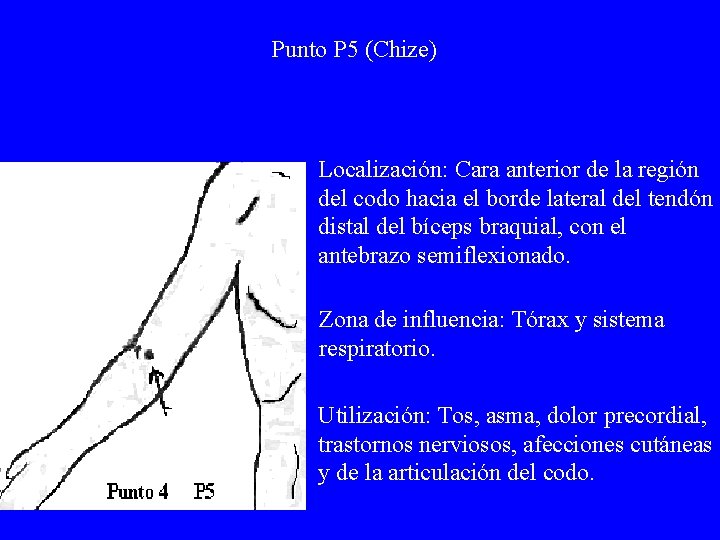 Punto P 5 (Chize) Localización: Cara anterior de la región del codo hacia el