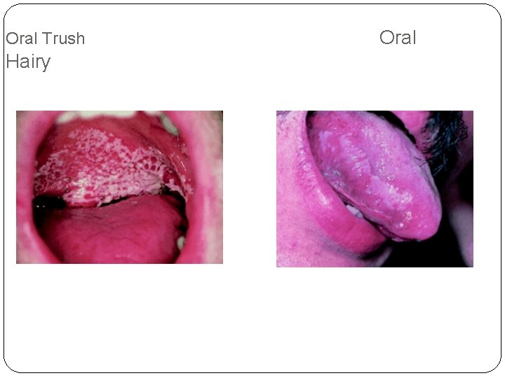 Oral Trush Hairy Oral 