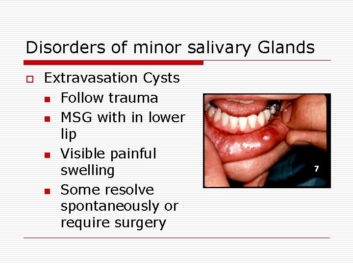 Disorders of minor salivary Glands o Extravasation Cysts n Follow trauma n MSG with