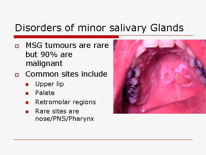 Disorders of minor salivary Glands o o MSG tumours are rare but 90% are